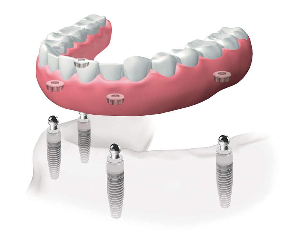 implantes dentales en Badalona