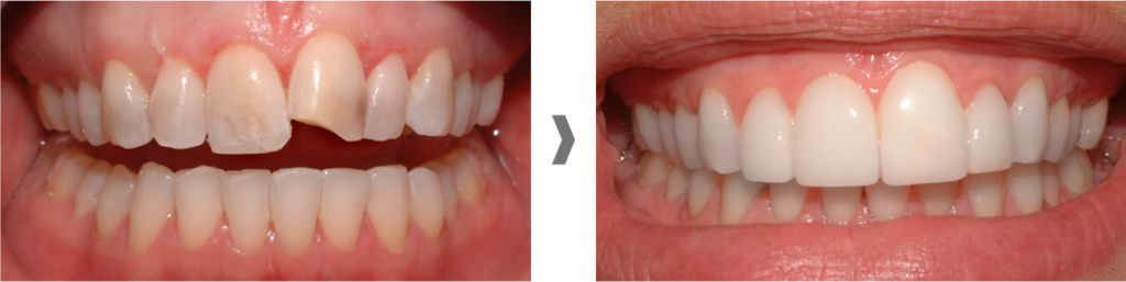 Carillas dentales sin rebajar el diente en Badalona