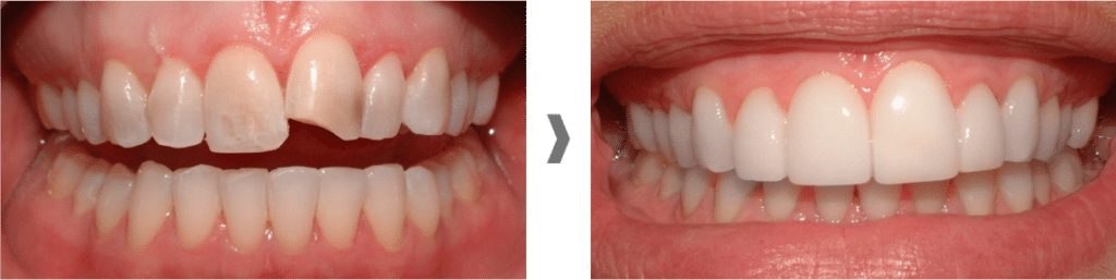 Carillas dentales sin rebajar el diente en Badalona