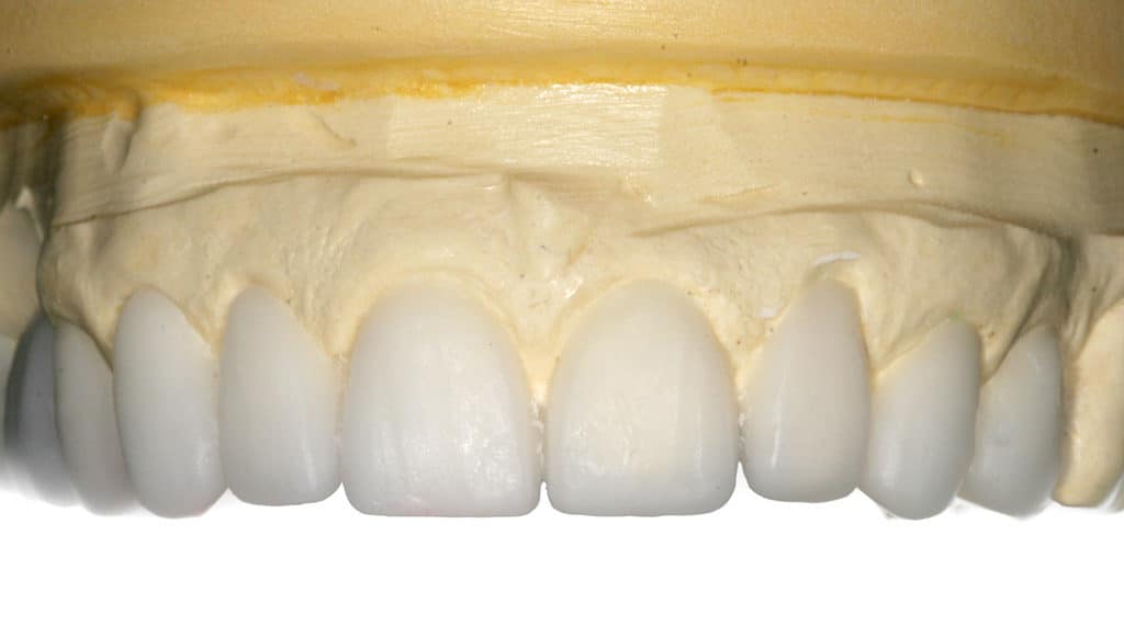 Carillas dentales sin rebajar el diente en Badalona