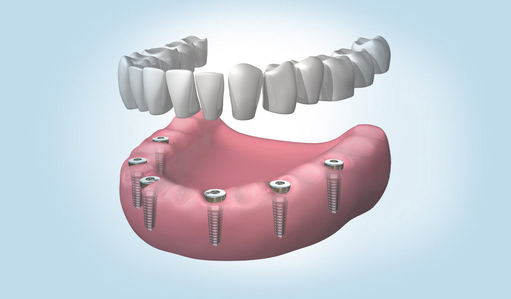 Dentadura fijada con implantes dentales en Badalona