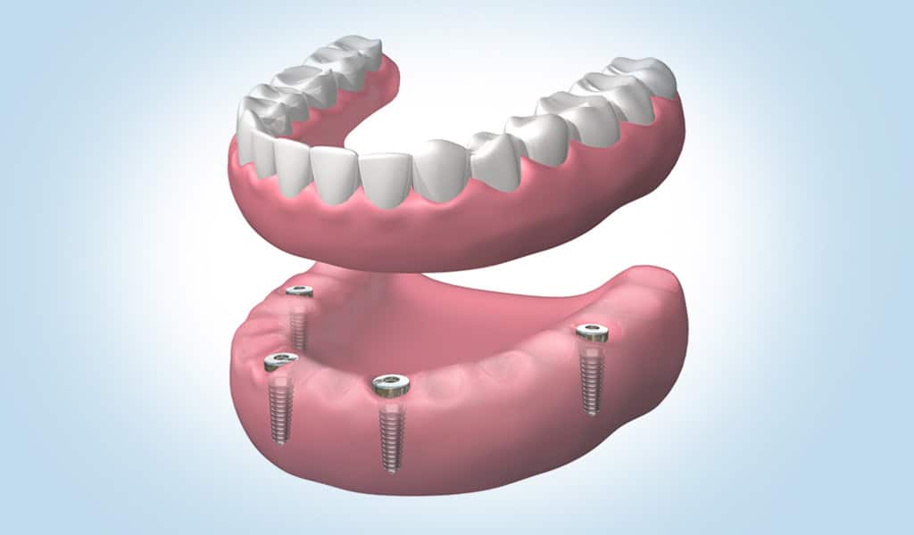 Dentadura fijada con implantes dentales en Badalona