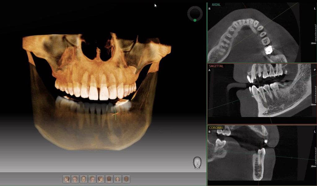 Dentadura fijada con implantes dentales en Badalona