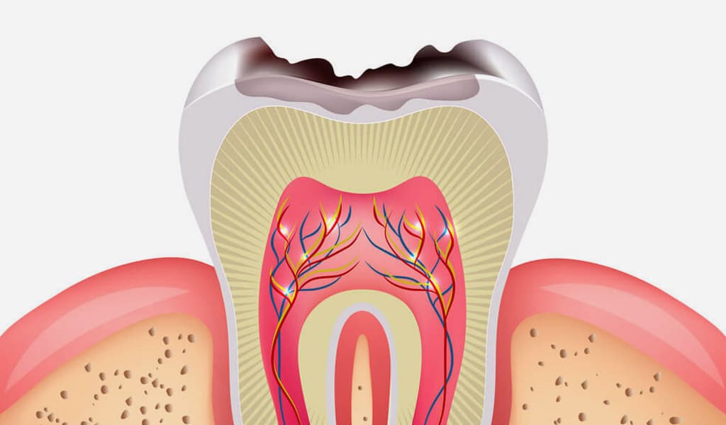 Prevención de caries en Badalona