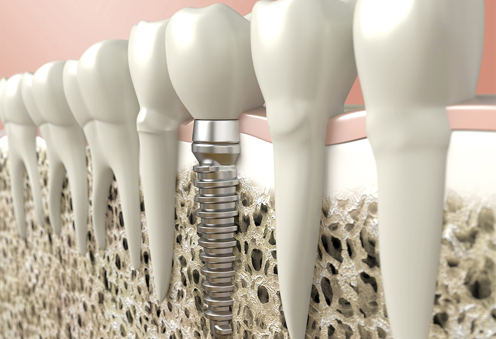 Implantología dental en Badalona