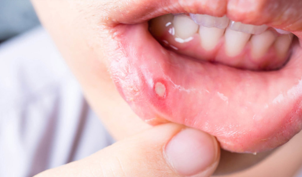 Infección de boca en Badalona