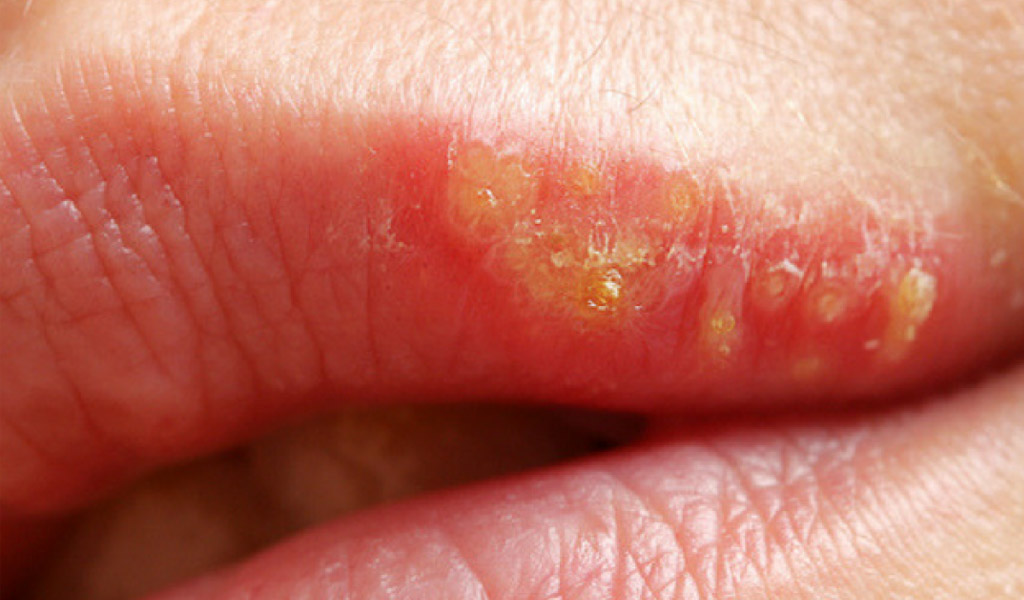 Infección de boca en Badalona