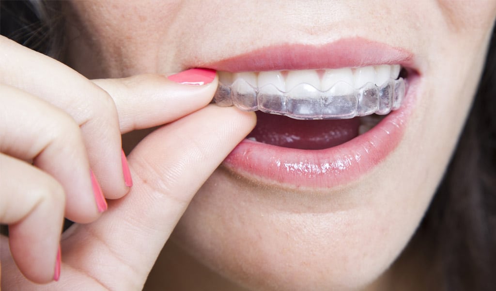 ortodoncia invisalign en Badalona