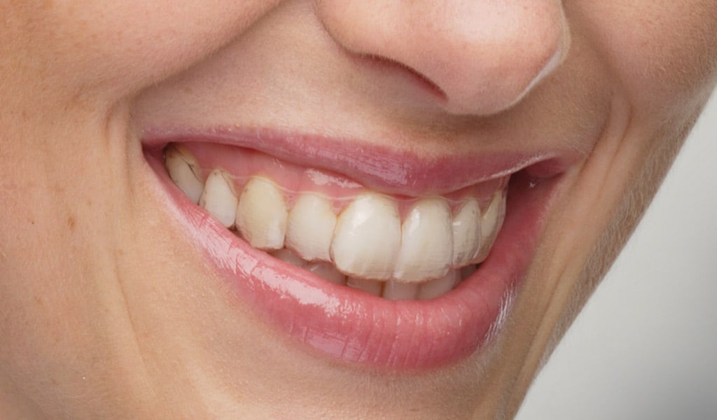 ortodoncia invisalign en Badalona