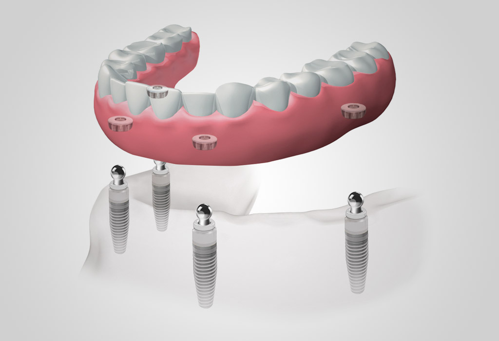 Necesitar Semejanza También Dentadura extraíble con implantes en Badalona | Clínica dental La Morera