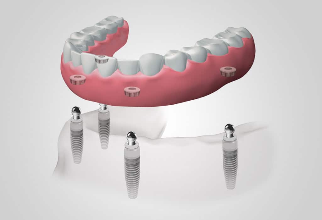 Dentadura extraíble con implantes en Badalona