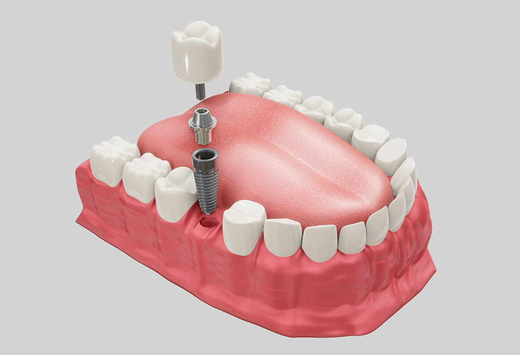 Implantes dentales de carga inmediata en Badalona