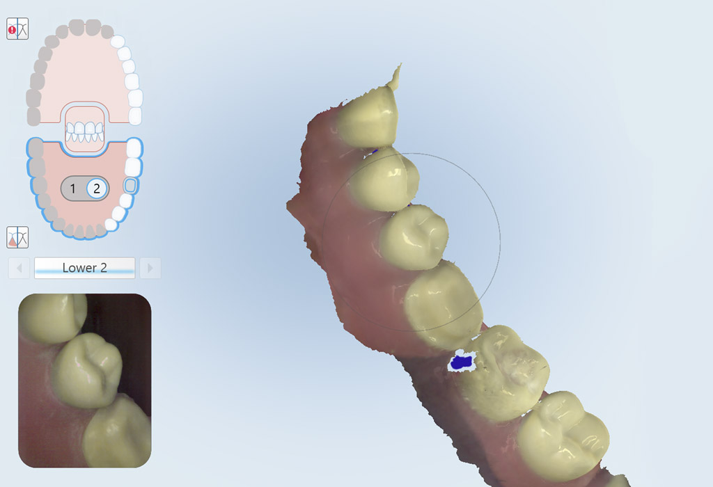 escáner 3D intraotral Badalona