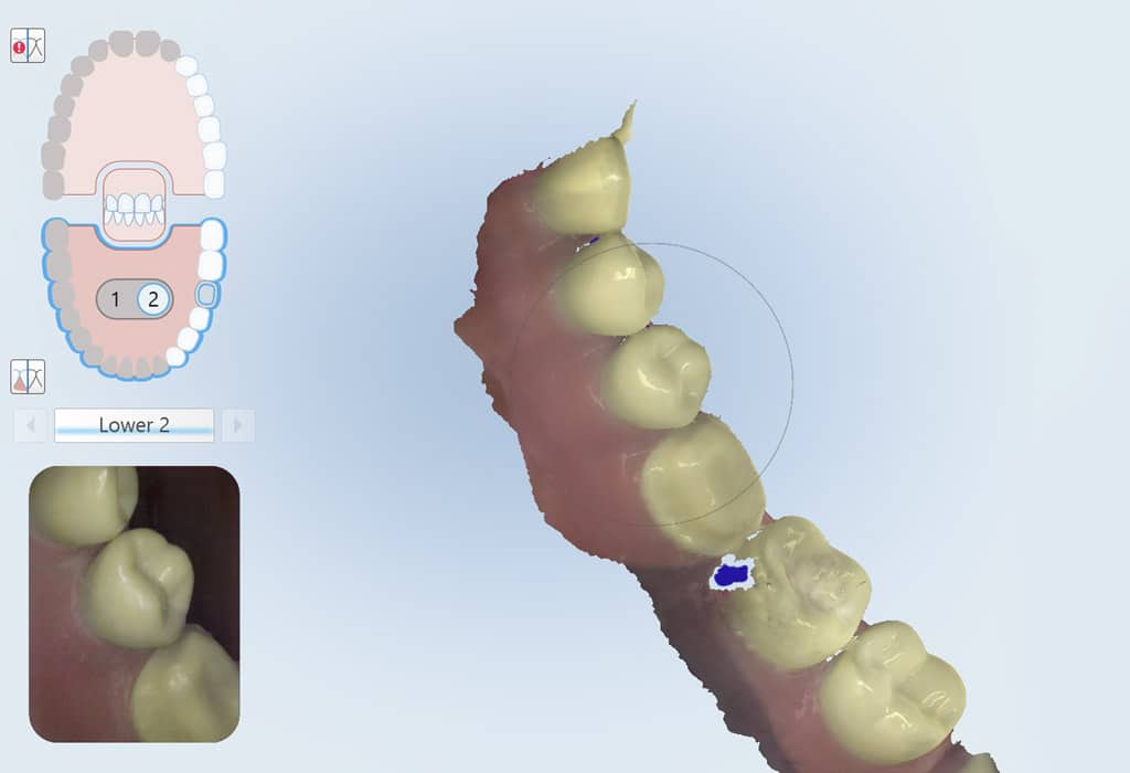 escáner 3D intraotral Badalona