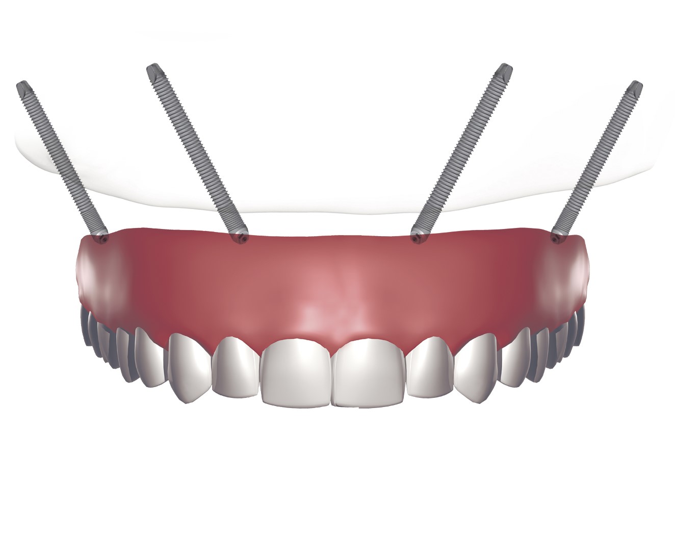Implantes dentales Badalona