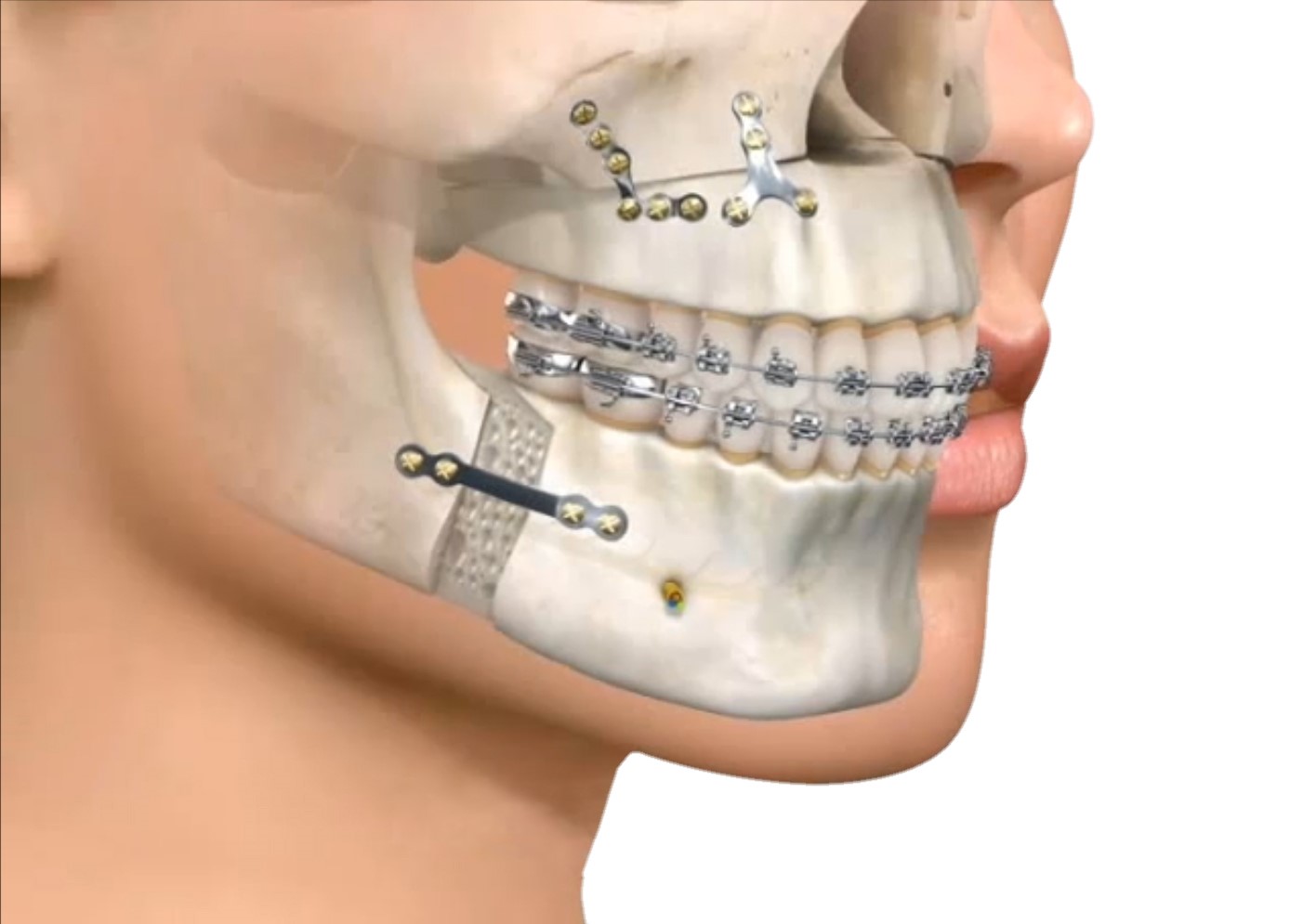 cirugía maxilofacial en Badalona