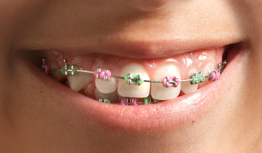 Ortodoncia infantil en Terrassa