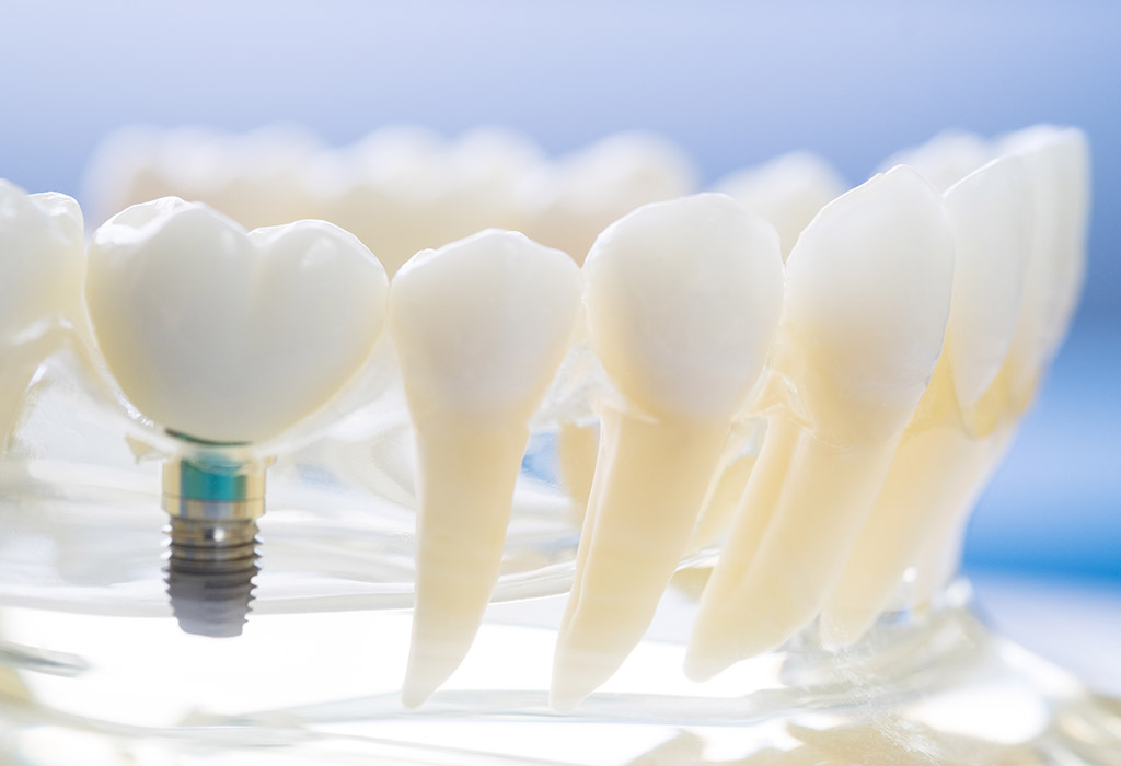 Implantes dentales en Badalona