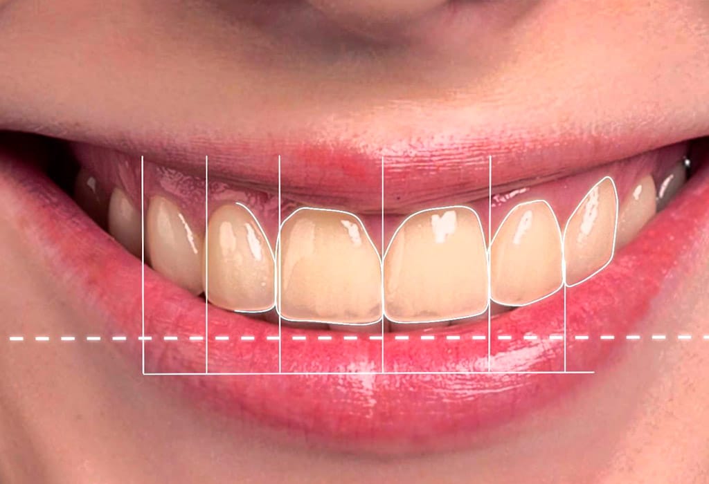 Carillas dentales en Badalona