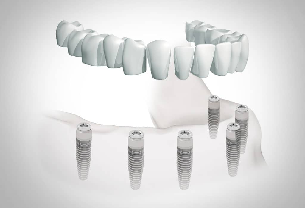 casos difíciles en implantes dentales en Badalona