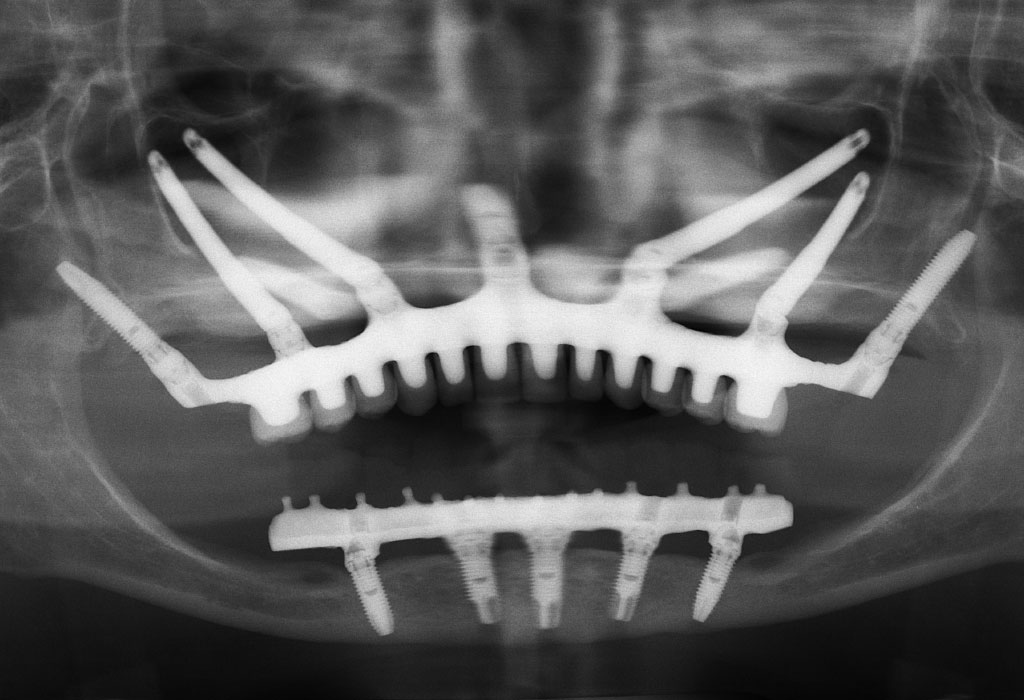 casos difíciles en implantes dentales en Badalona