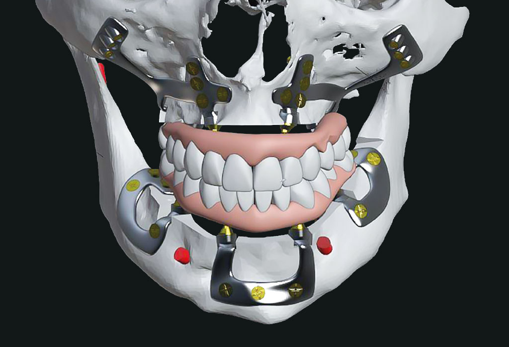 Implantize en Badalona - casos difíciles en implantes dentales en Badalona