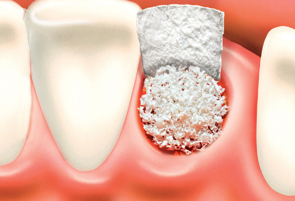 Casos difíciles: injertos óseos para implantes dentales en Badalona