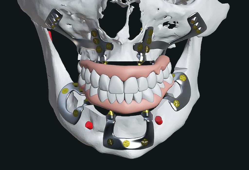 Complicaciones implantes dentales